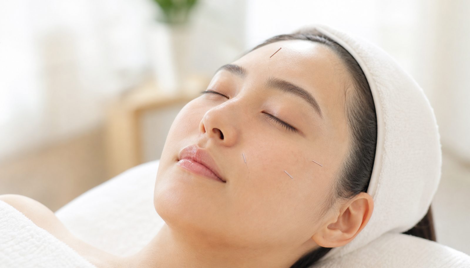 美容鍼の施術イメージ（お顔に細い鍼を打った女性）
